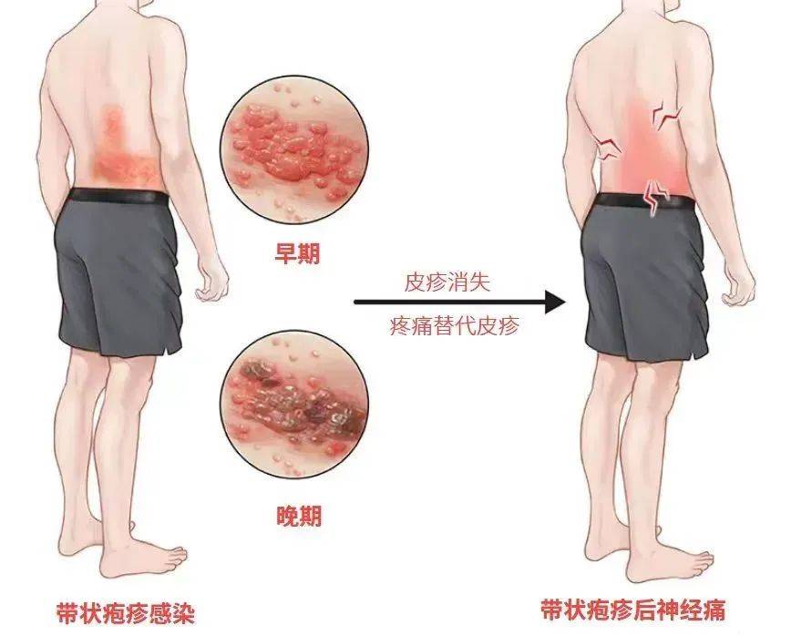 皇冠信用网会员开户_一旦感染终身携带皇冠信用网会员开户!深圳疾控提醒:这4类人要注意