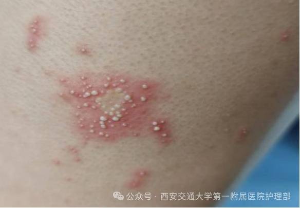 皇冠信用盘_西安多区发现隐翅虫?千万别拍皇冠信用盘!毒液堪比硫酸